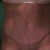 Front view of scar at 4 weeks