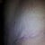 pic of left hip scar. 4wk