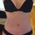 Almost 11 weeks post op. Looking pretty hot in my sexy underwear!