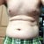 Pre-op torso (slightly bending over)