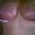 front view 4 weeks post