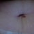 Day 6 post-op. Belly button is discharging slight liquid and has some crust but doesn't hurt.
