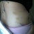 Day 6 bruising is almost gone. Drains are putting out very little.