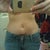 3 months post op.