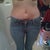 3 months post op.