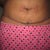 DAY 24 CLOSE UP OF INCISION LINE