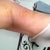 6 days post op