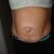 Pre-Op Front Shot