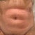 3 day post op front