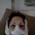 After surgery