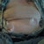 my drains the day of explant