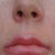 Upper lip after Vitrase