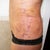 side pic after surgery
