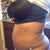 Tummy lipo 2-23-2013
