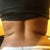 Back lipo 2-23-2013