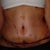 10 days post op tt scar close up. Still has the steri-strip on