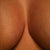 4 Weeks post, cleavage scars