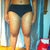 Post op legs - 4 weeks
