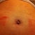 Aug. 26 (4 wks 3 days PO) BB after a shower.  Blob of tissue.