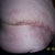 10 days post op -73 staples and 7 sutures removed.Very swollen,but happy!