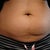 Before photo close up of stomach. Notice the stretched out shape of belly button, stretch marks, bulging and loose skin on lower abdomen