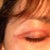 A hollow forming on the middle of the face