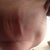 sag and wrinkle chin after a month since surgery