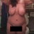 1 week post op