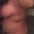 1 week post op - a lot of bruising apparent