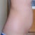 Pre surgery