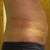 1 week after
you can see the lumps and bruises