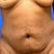 before-abdominal