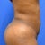 after- 1 week post op