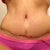 The curtains up, the bad area. It has settled down quite a bit. So her she is 28 day post op & 1 week later from tape removal.