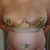 5 days Post surgery, still swollen, but getting there. :)