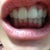 Day 1 with invisalign on