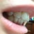 The side view doesn't do justice to how large the gap is between my upper jaw and lower jaw