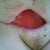 here you can see the new skin growing in which was removed by the infection in May.