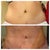 Before with tt after touch up lipo