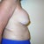 Right side. (this was the smaller breast before implants)
