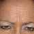 Before Botox