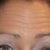 Before Botox
