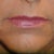 Before Juvederm..and lots of makeup!