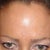 After 40 units of Botox