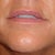 After 2 syringes of Juvederm