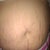 The stretchmarks  :(