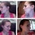 Comparison shots (Day of cast removal shots)