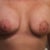 Front view 3 weeks post op. Nipples are low, and implants too high.
