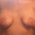 Front view 3 months post op. 
Facing photo right breast is on the right side of photo.