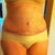 4 wks post-op.
